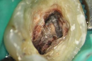 endodoncia-05